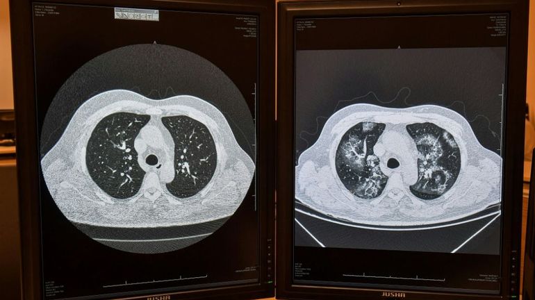 Au Brésil, l'intelligence artificielle pour les diagnostics de Covid-19