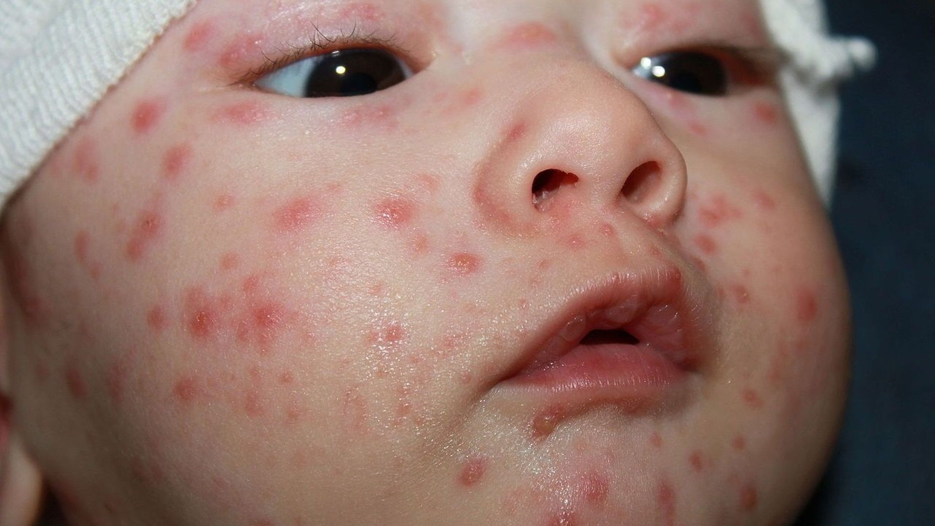 Épidémie de varicelle en France fautil s'inquiéter à la veille d'un