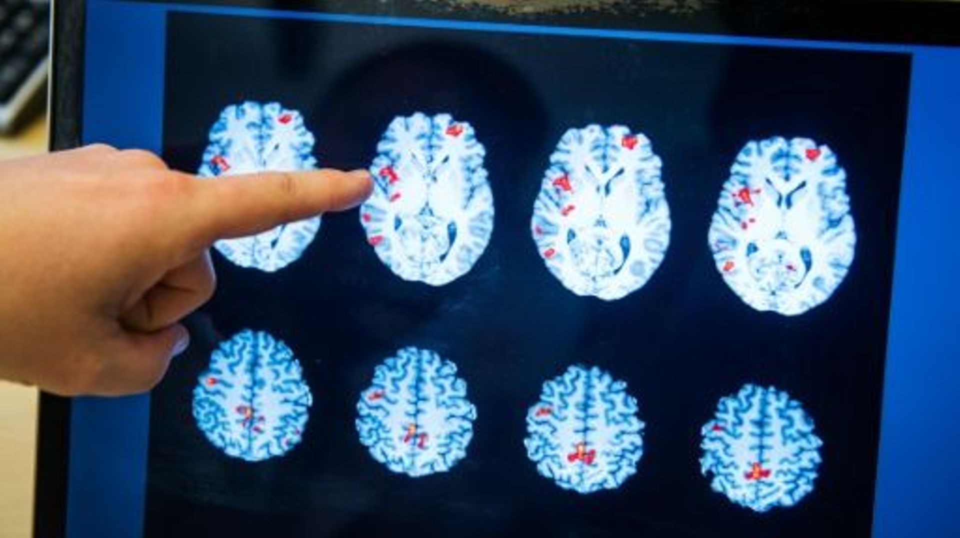 Un médecin montre les zones d'activité du cerveau d'un homme sujet à des phantasmes pédophiles, à l'hôpital Huddinge à Stockholme, le 15 avril 2016 
