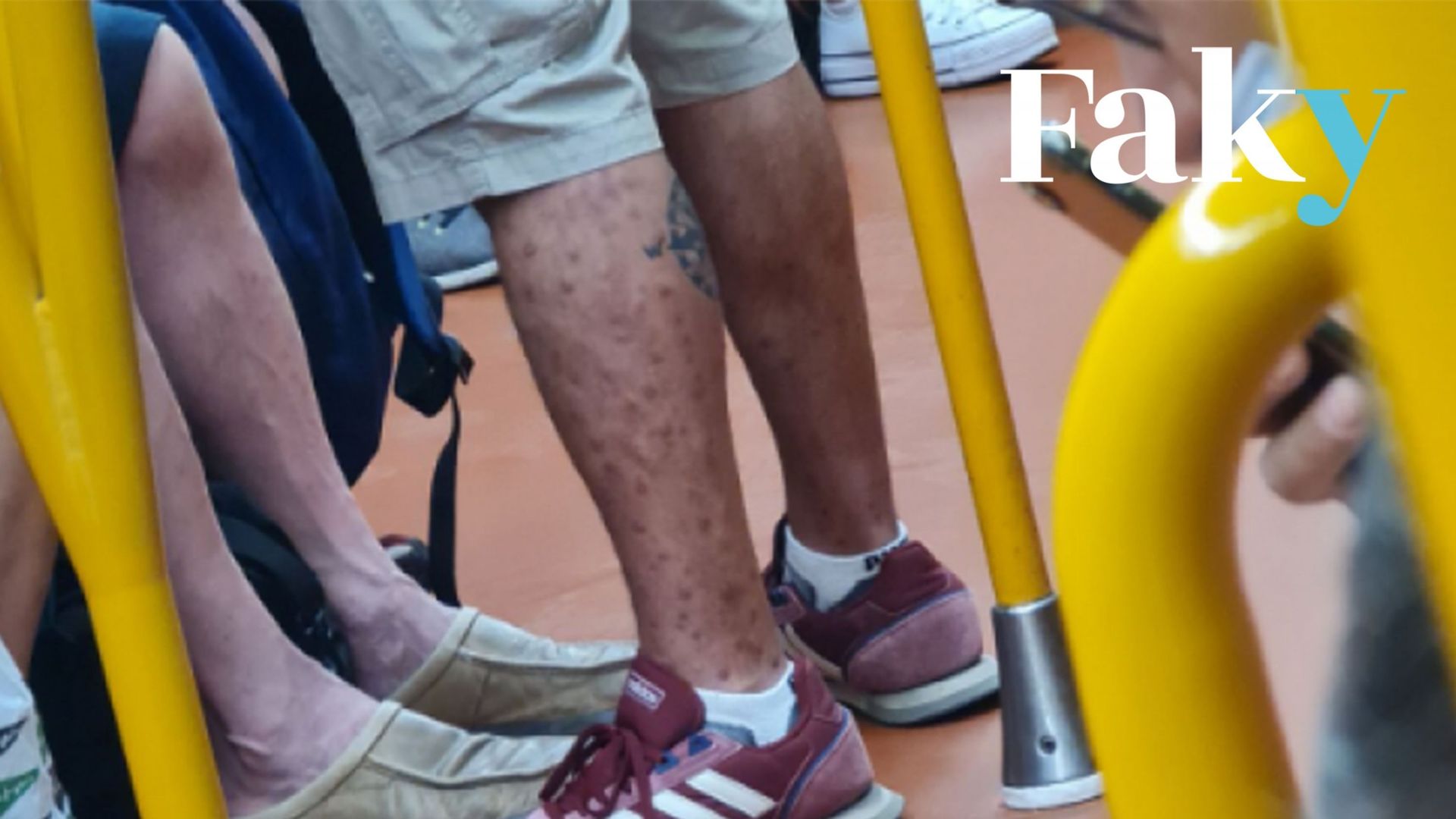 Photographie publiée sur Twitter d’un homme dont les jambes sont couvertes de boutons, dans le métro de Madrid.