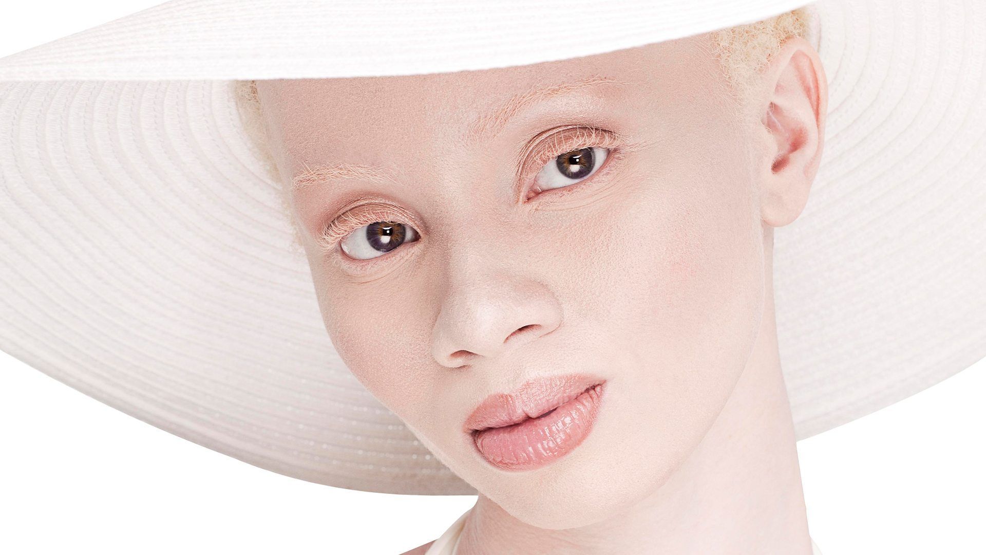 Afrique de l'Est : les albinos sont persécutés, victimes de croyances et de sorcellerie