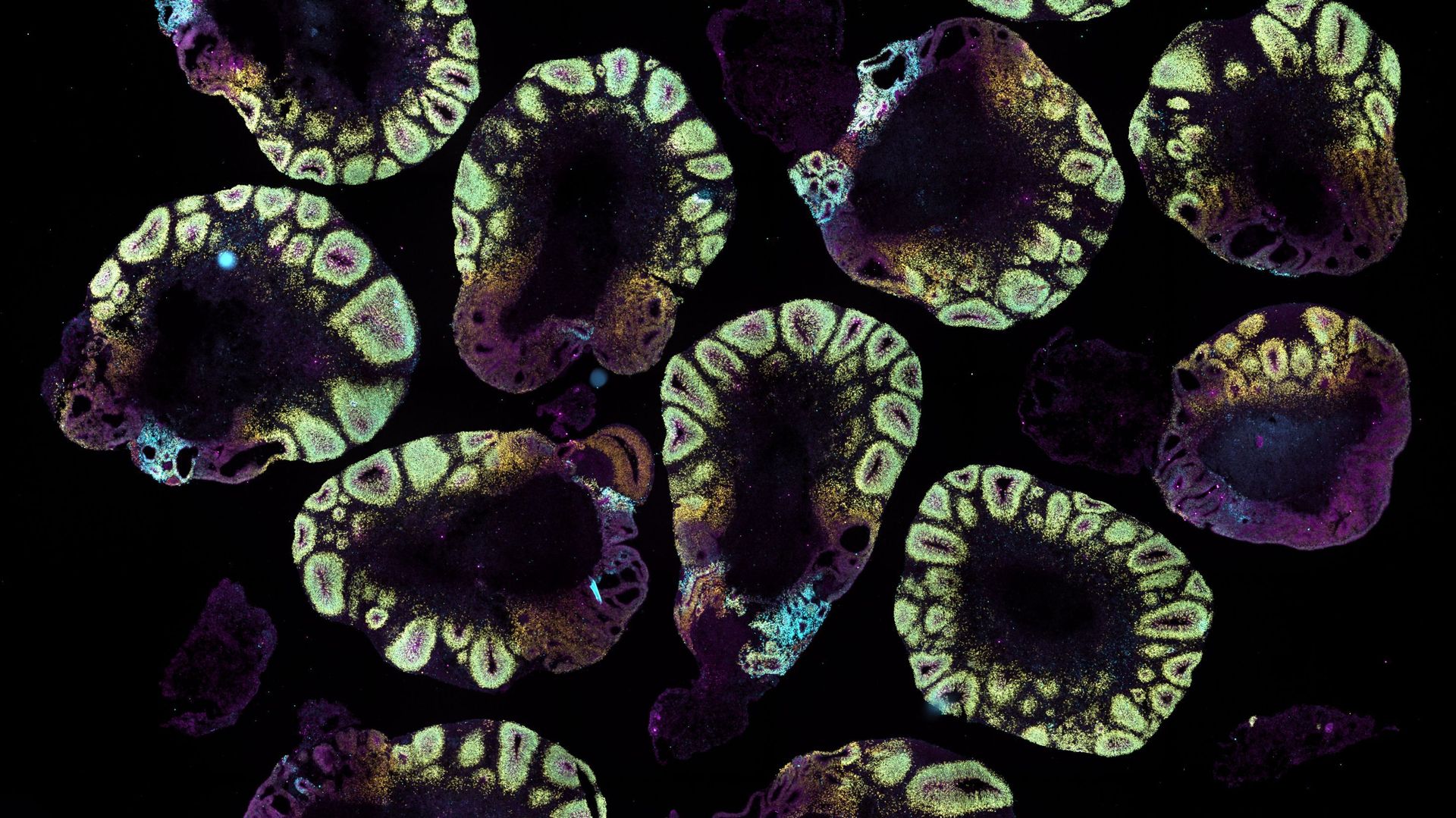 Sur cette deuxième image issue d’un autre groupe d’organoïdes, on reconnaît essentiellement les rosettes formées par les cellules progénitrices neurales.