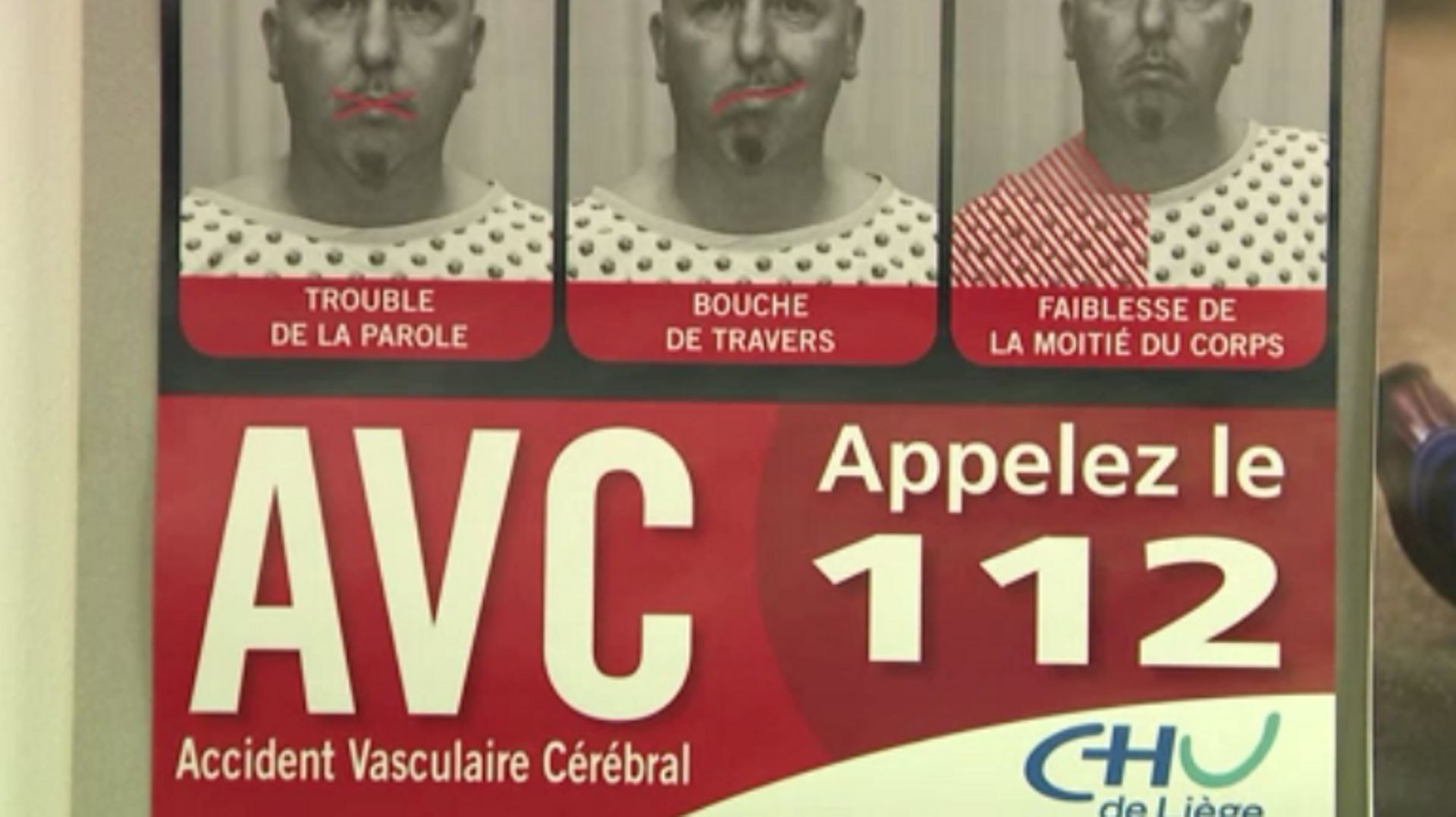 Diminution des cas d'AVC : le CHU de Liège tire la sonnette d'alarme