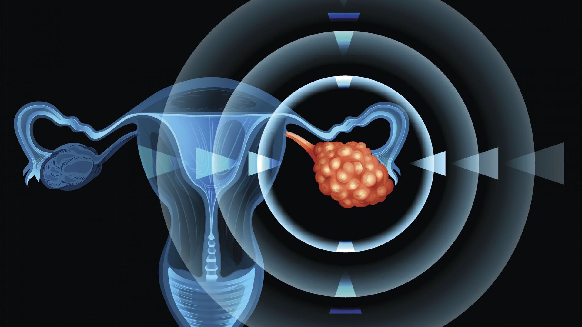 La KULeuven développe un test permettant un traitement personnalisé contre le cancer de l’ovaire. Illustration du cancer de l’ovaire
