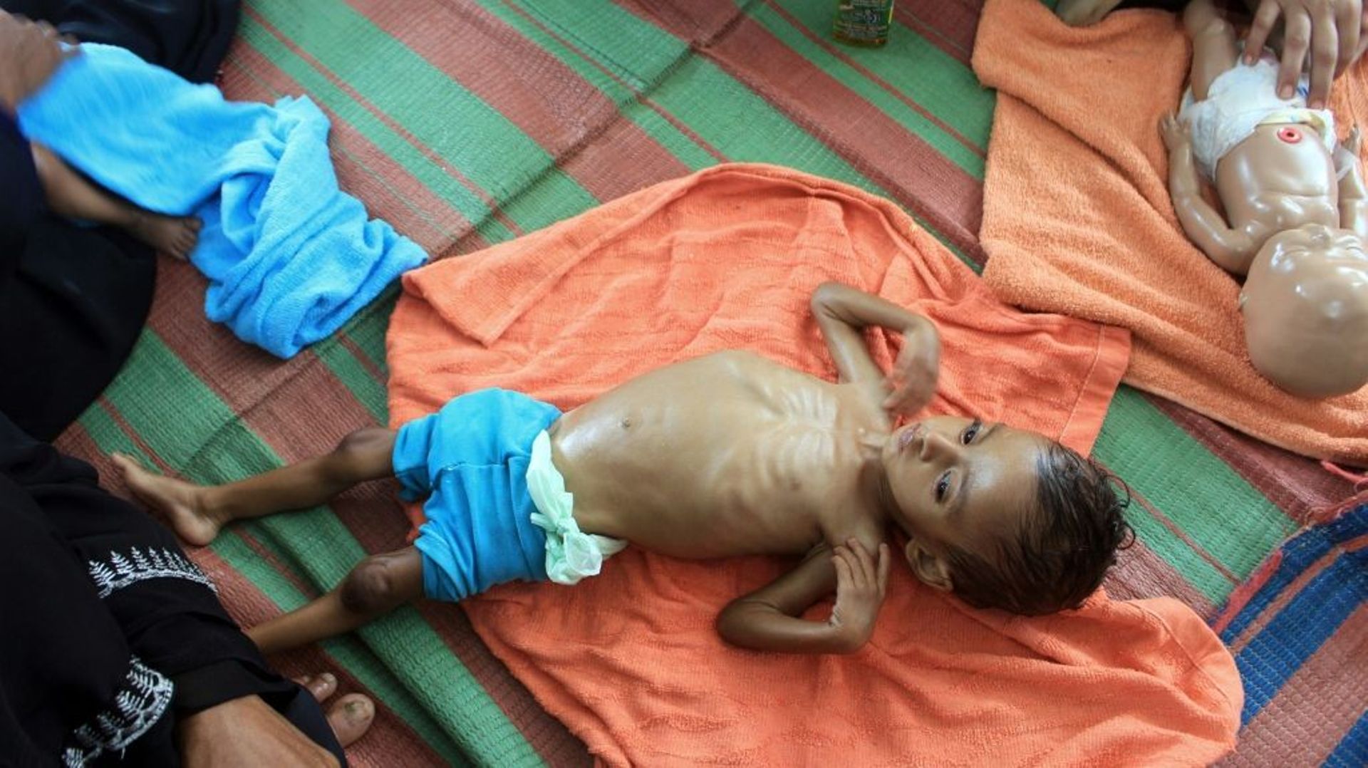 Un enfant yéménite souffrant de manultrition dans le nord du Yémen le 20 janvier 2021.