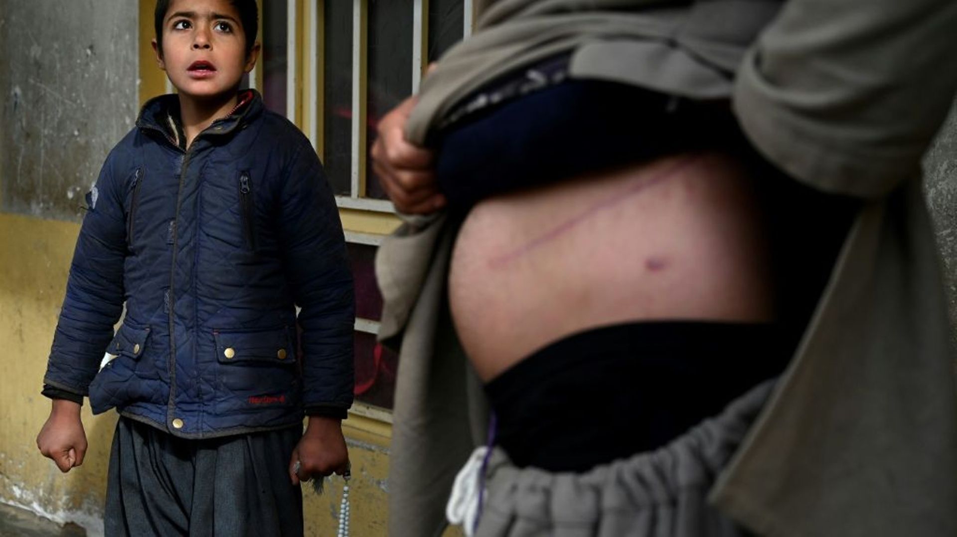 Nooruddin, qui a vendu son rein pour aider sa famille, montre sa cicatrice, le 4 février 2022 à Hérat, en Afghanistan
