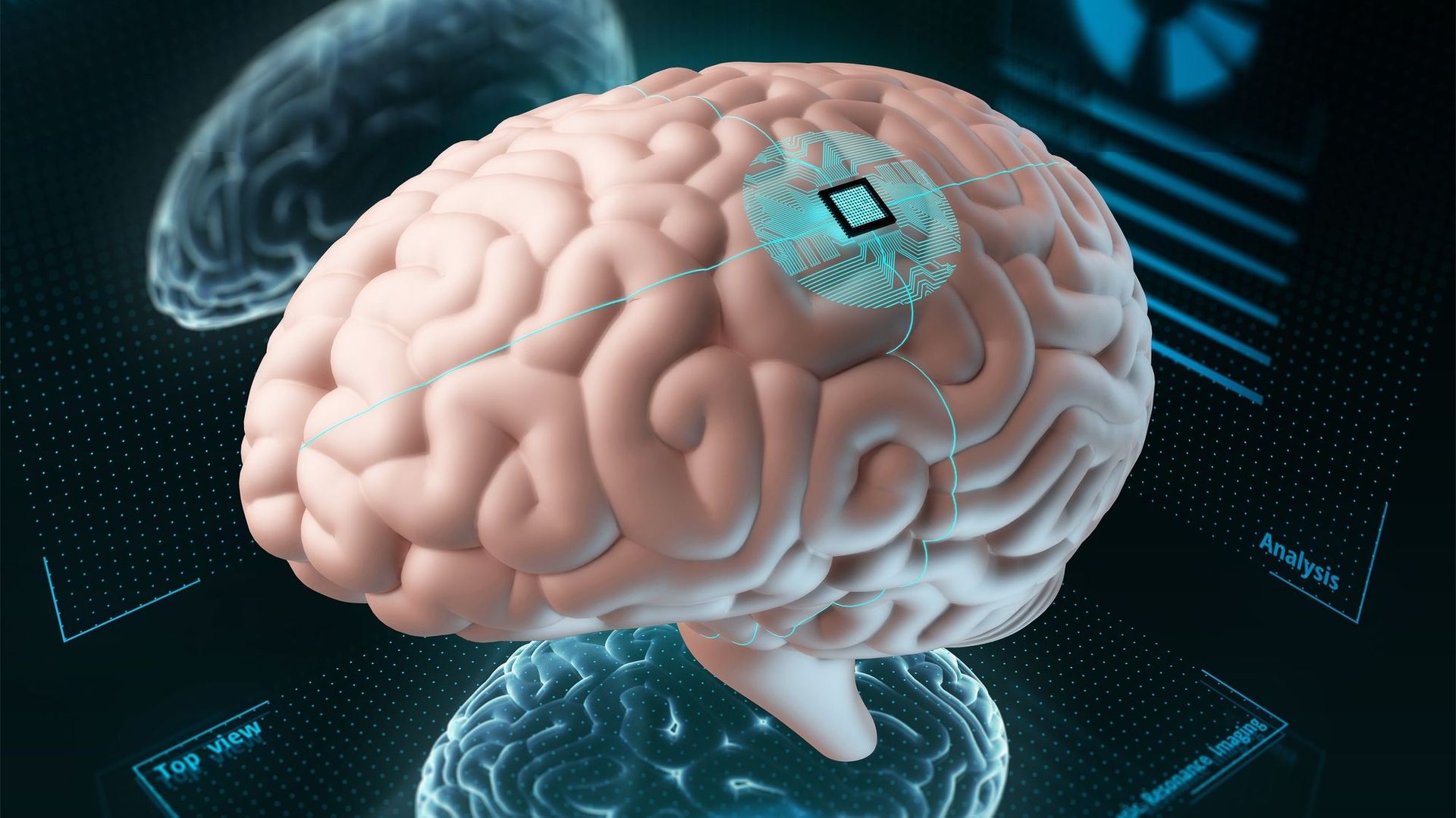 Science : des implants cérébraux pour soigner nos maladies. Est-ce possible ?