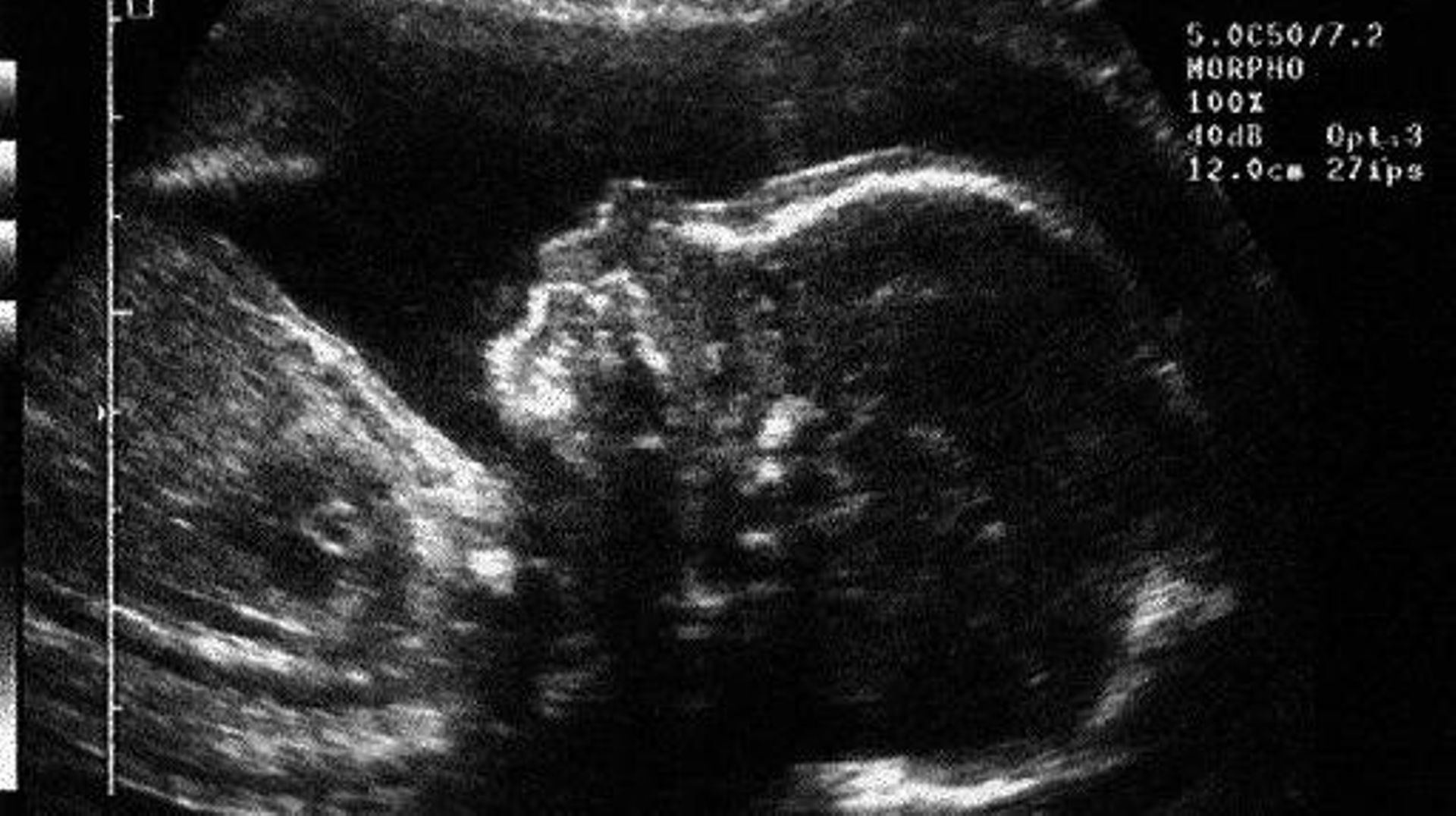Une échographie d'un foetus, environ cinq mois après la conception