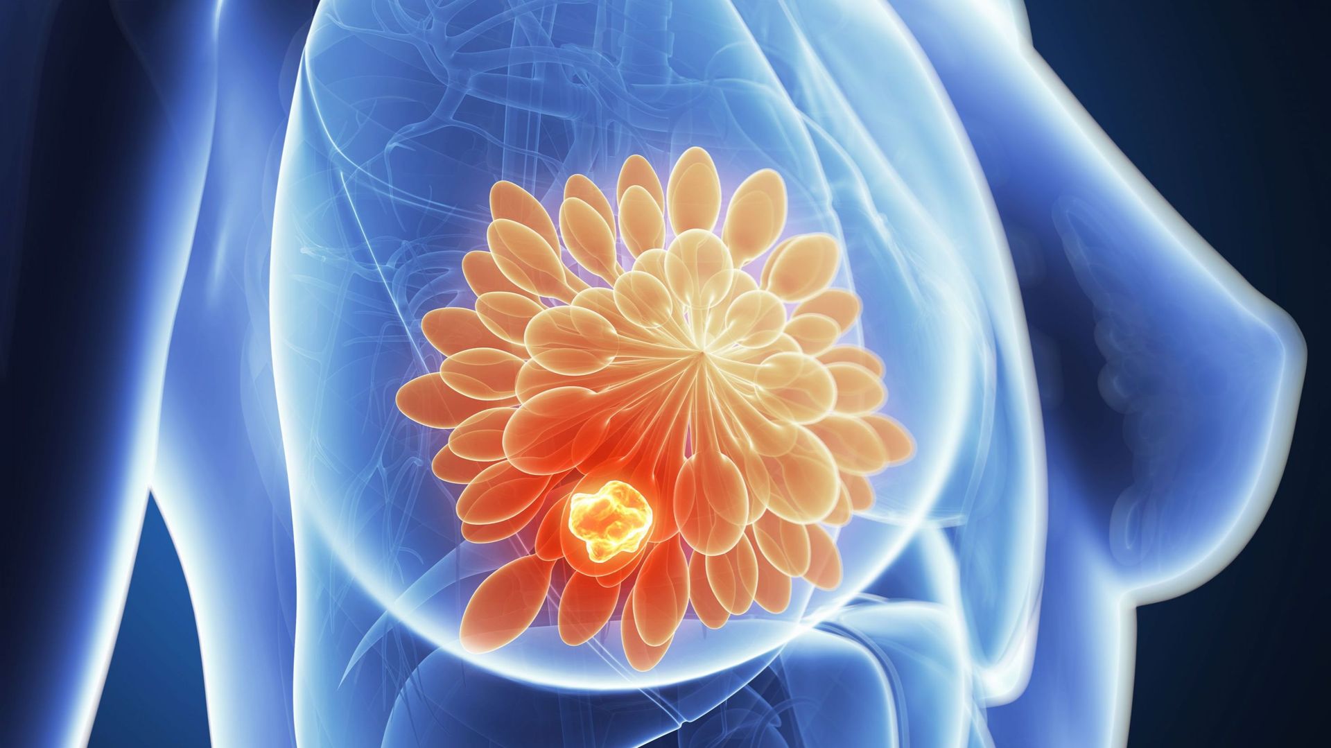 Le cancer du sein métastatique est toujours incurable: 'C'est ...