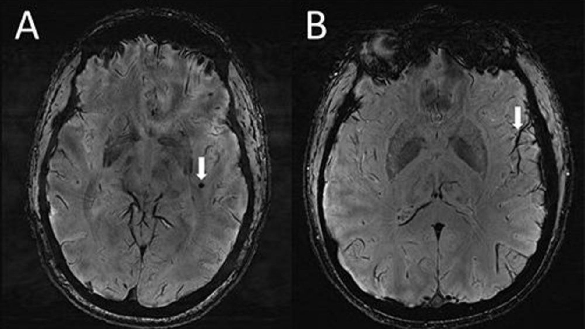 The brain changes seen in migraine sufferers could hold the key to treatment