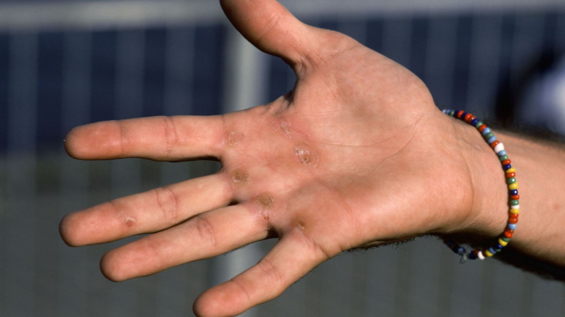 Rower&#39;s Callused Hand
