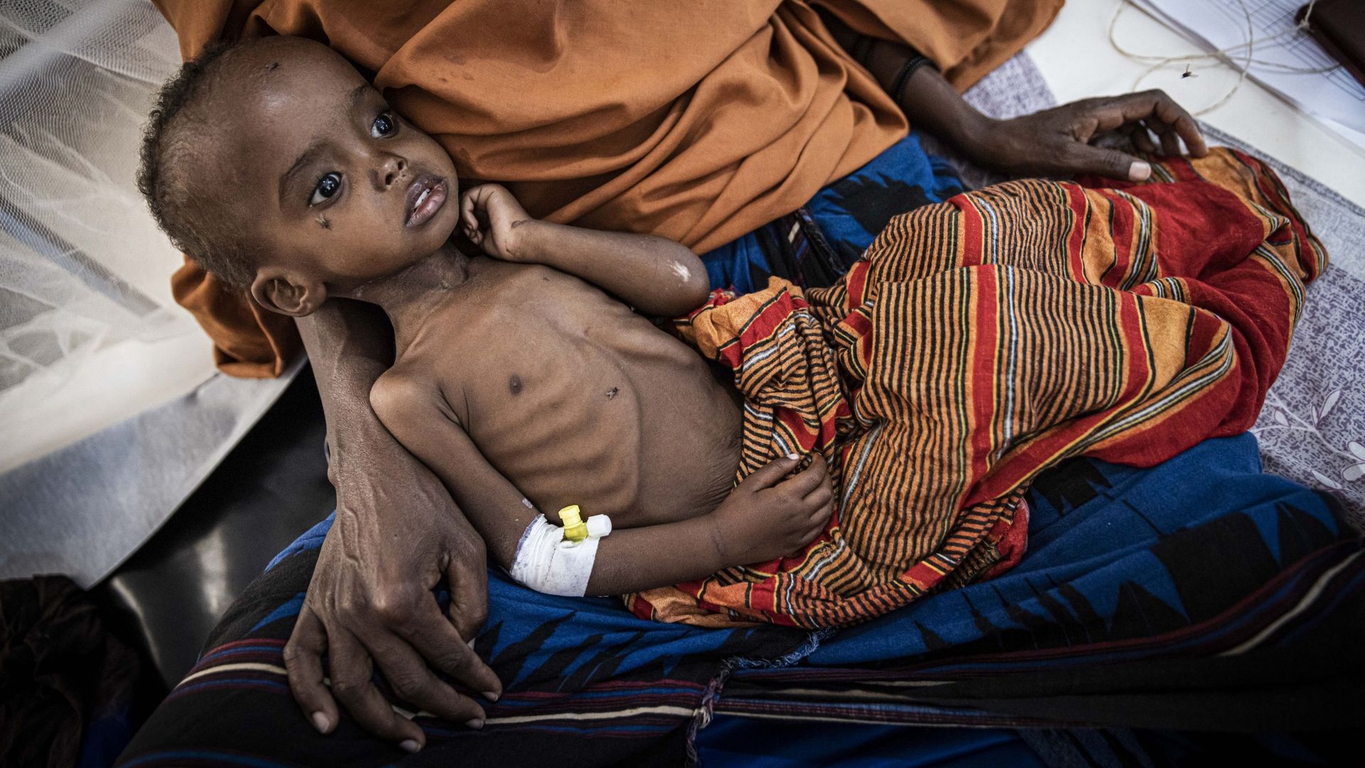 Jeune enfant souffrant de malnutrition sévère aiguë au camp de Baldoa en Somalie en 2022