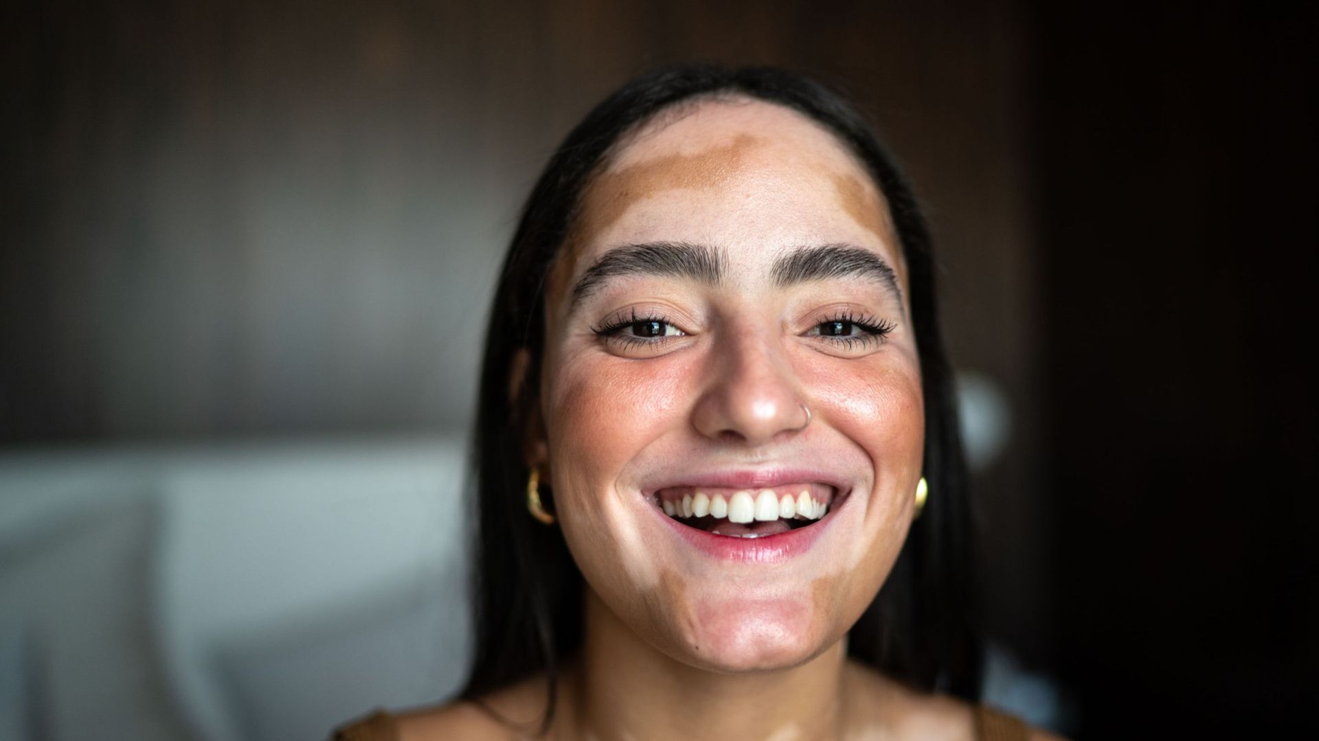 Portrait of a young woman with vitiligo at home