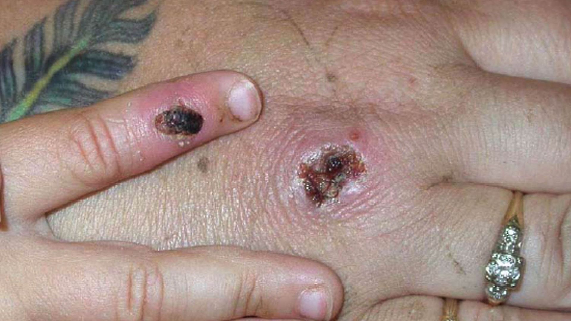Lésions provoquées par la variole du singe. Photo d’illustration.