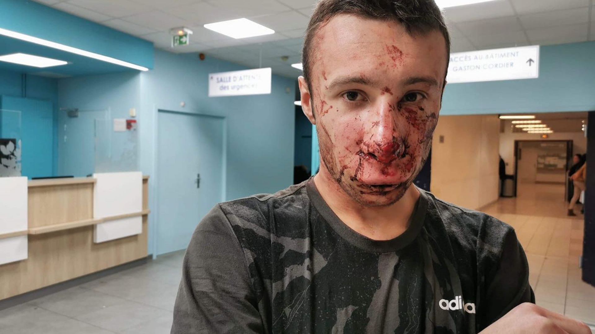 Gilets jaunes: un journaliste atteint au visage par une grenade à Paris, le vrai du faux