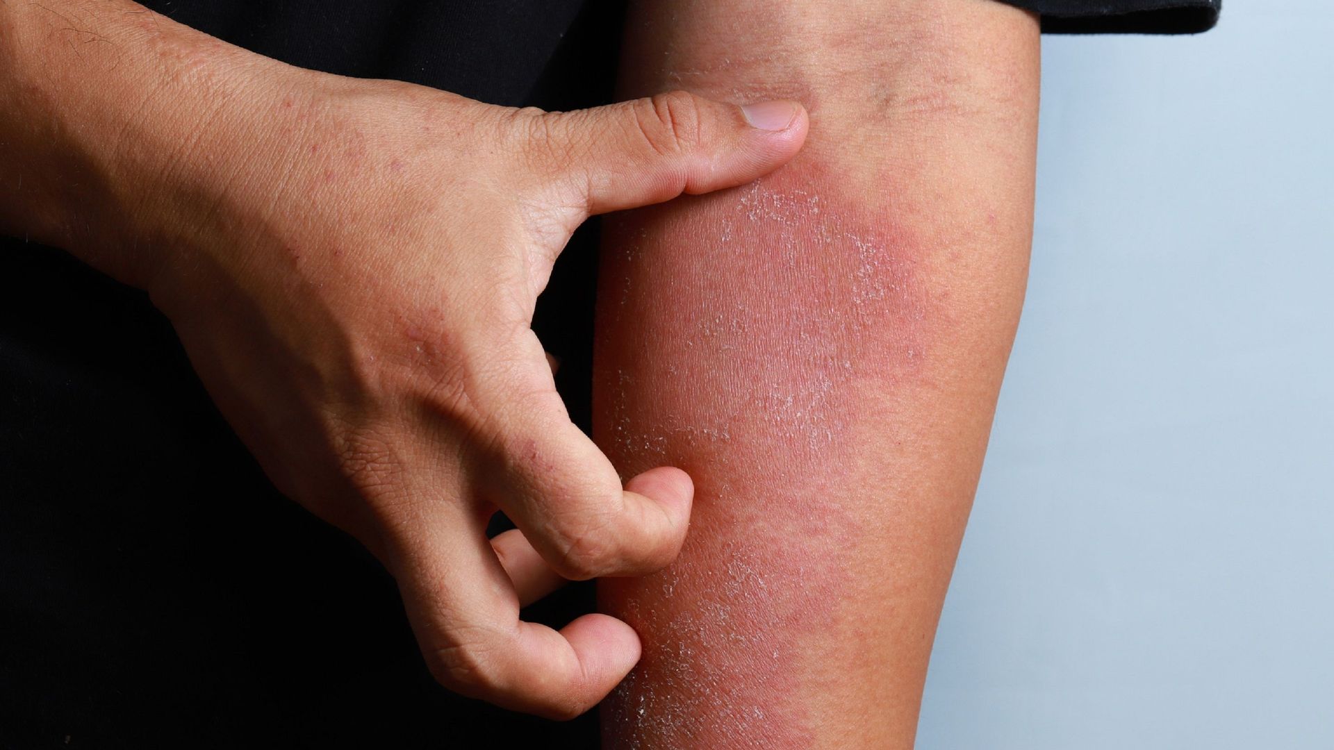 Absentéisme, mal-être : comment aider les ados à mieux vivre avec la dermatite atopique ?