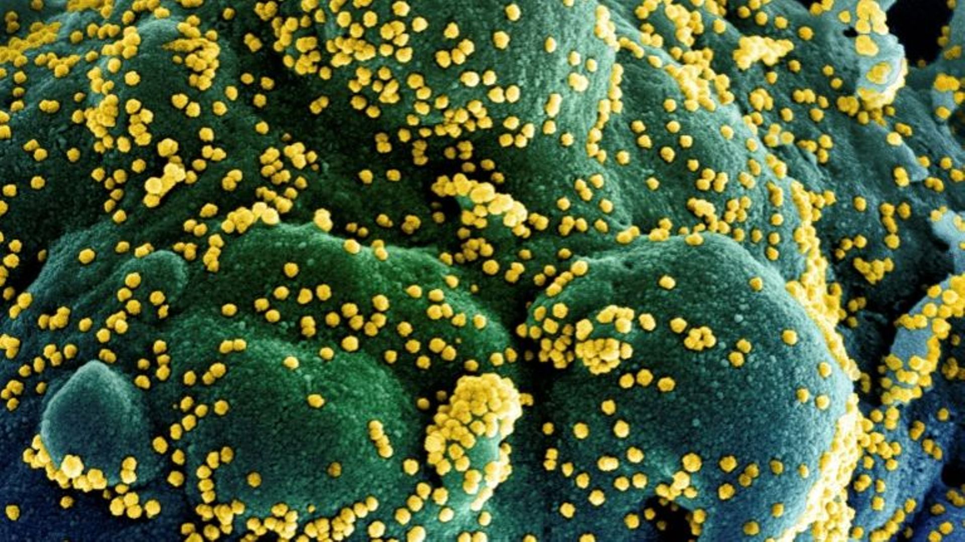 Une cellule infectée par le coronavirus - photo colorisée