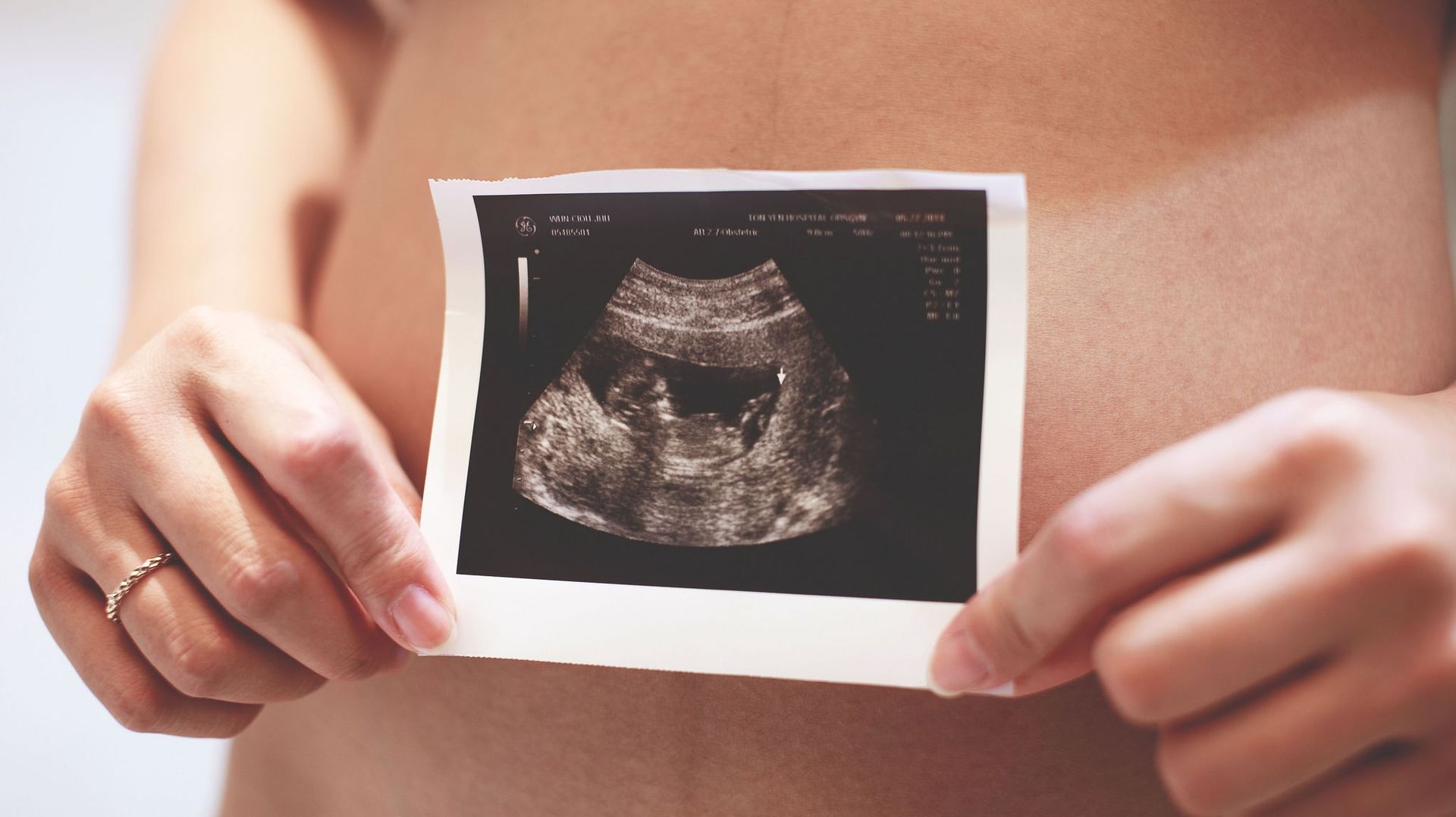 Le test prénatal non invasif, la technique la moins contraignante pour diagnostiquer le syndrome de Down chez le fœtus.