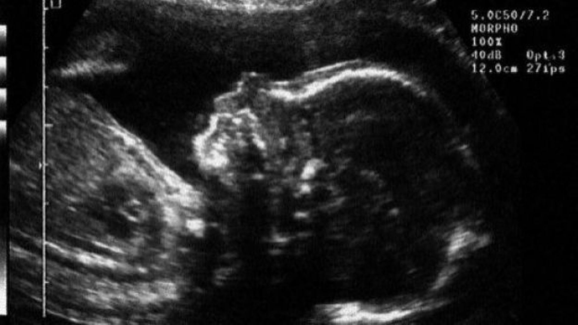 Une échographie d'un foetus