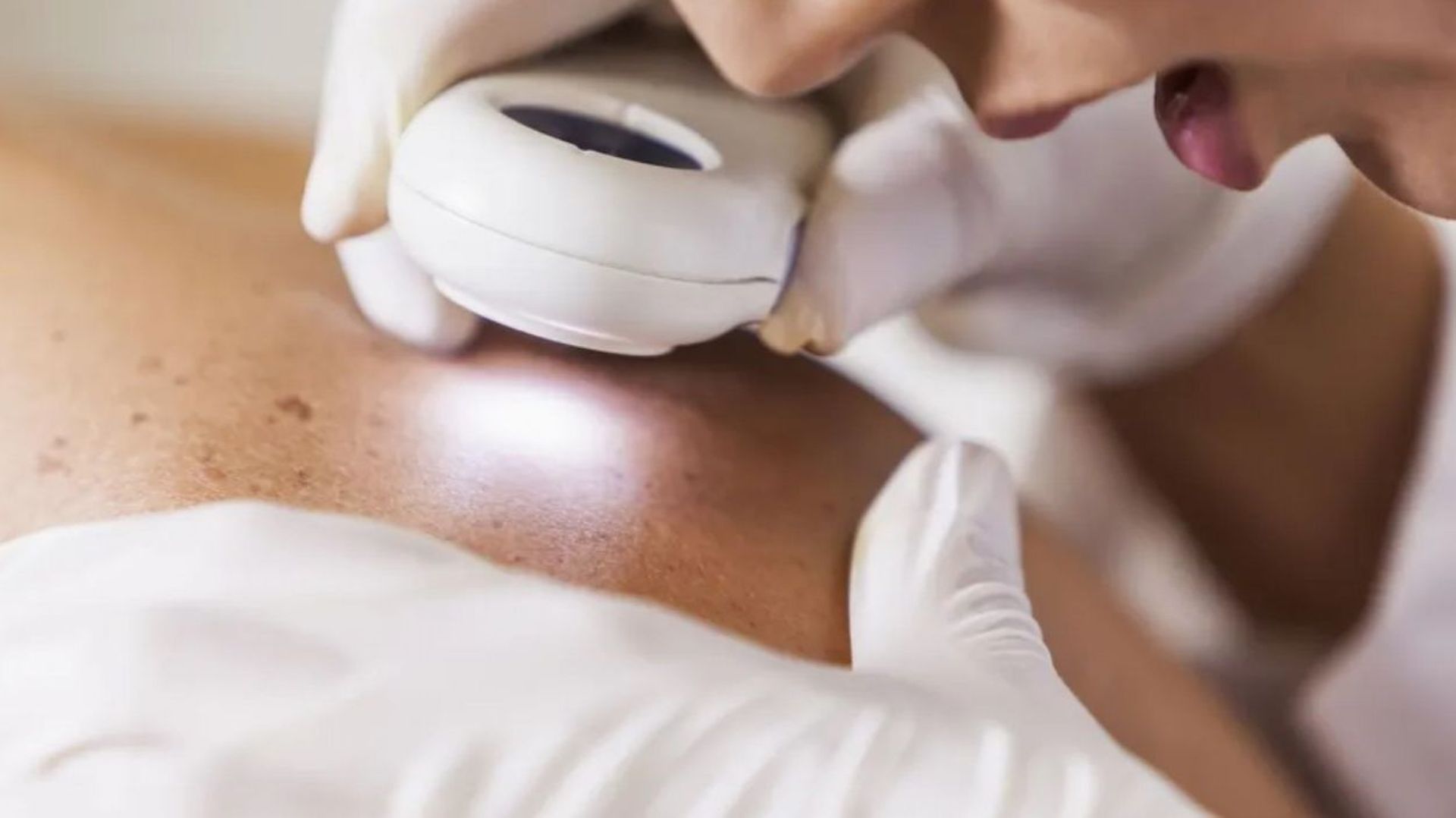 Le CHRSM lance "Dermato Express", une consultation pour détecter rapidement un cancer de la peau