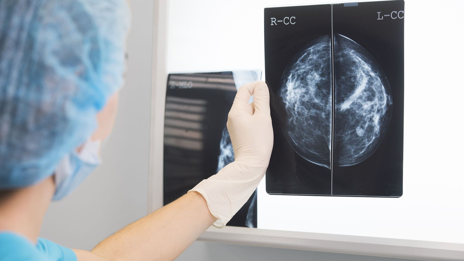 Diagnostic du cancer du sein: l'intelligence artificielle peut faire mieux que l'humain.