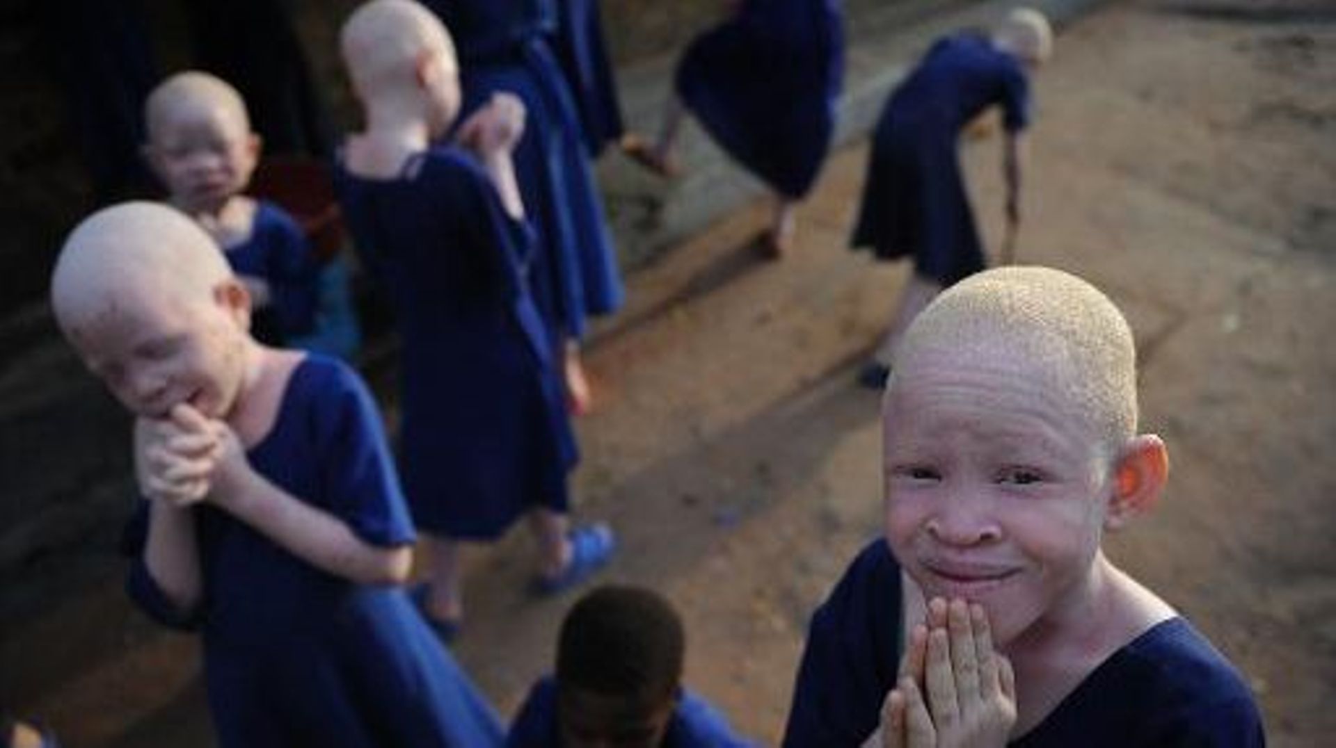 albinos-en-tanzanie-une-vie-de-stigmatisation-et-de-violence