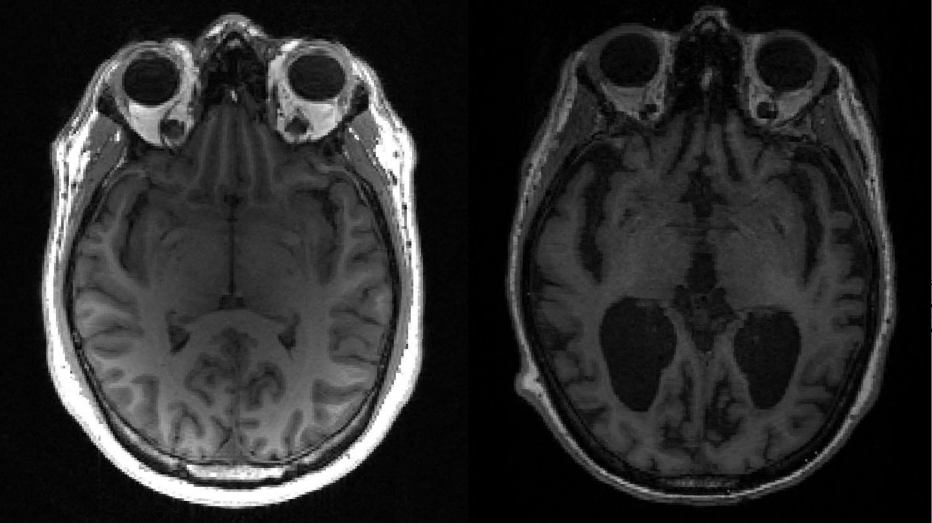 Image non datée montrant un cerveau sain et un cerveau atteint par la maladie d’Alzheimer