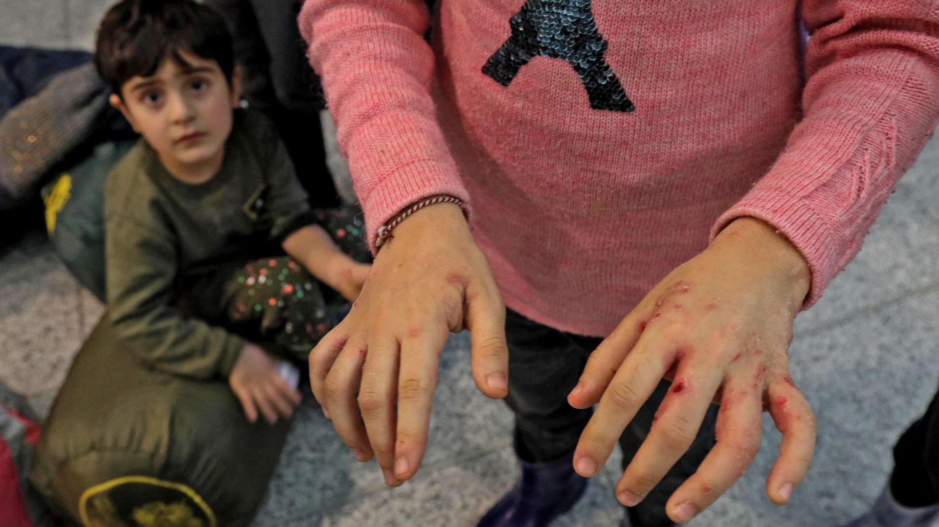 Une personne originaire d’Irak, rapatriée de Minsk, présente des blessures aux mains causées par un froid extrême subi alors qu’elle tentait d’entrer dans l’UE depuis la Biélorussie, le 26 novembre 2021