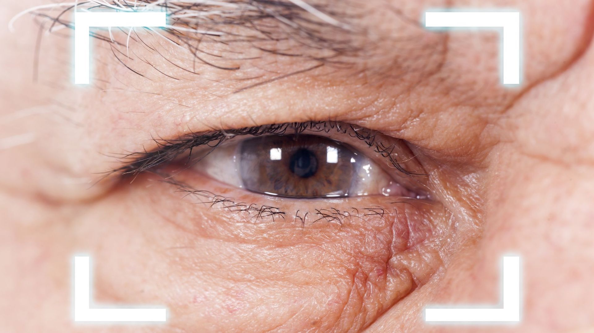 Comment soigner la cataracte ? 