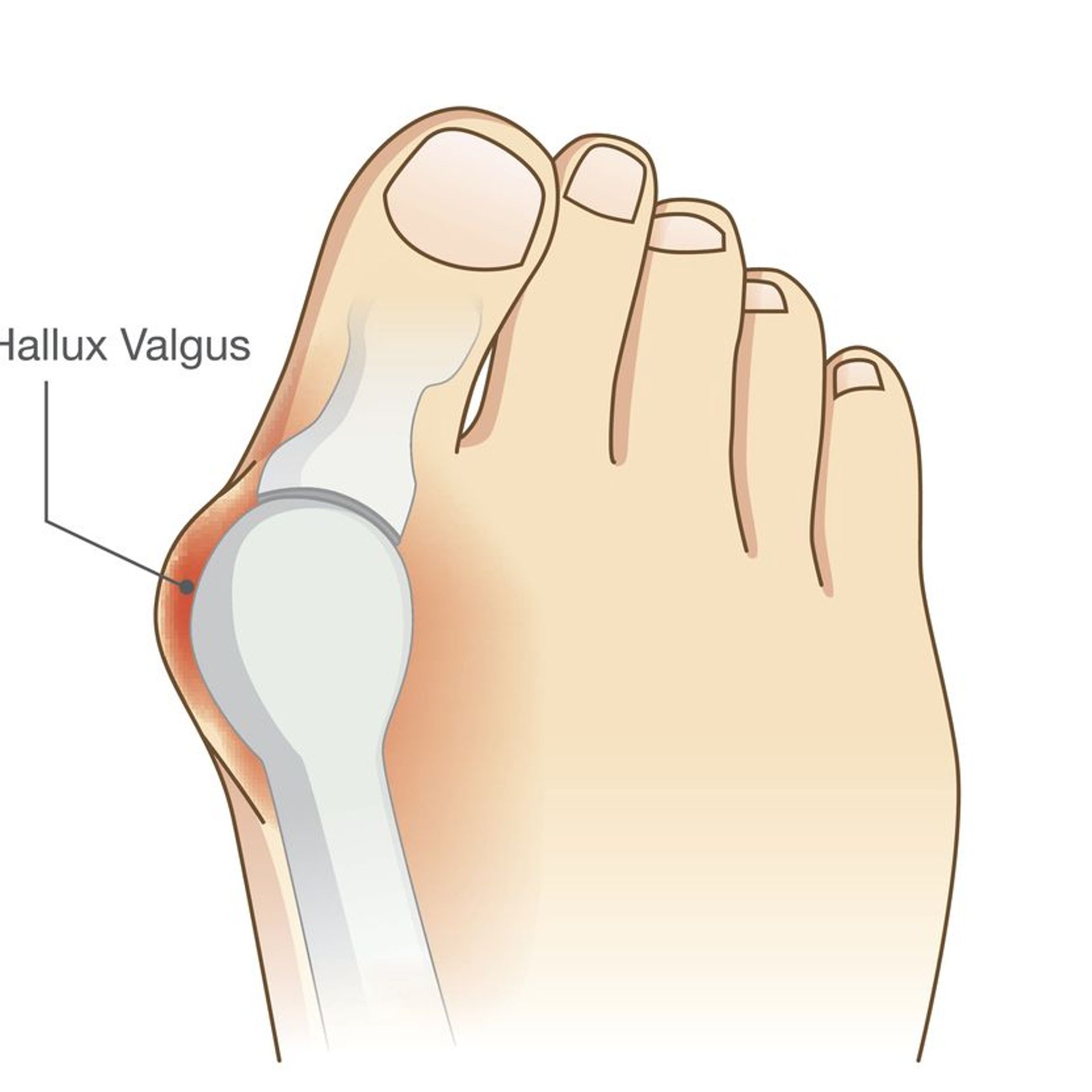 Hallux valgus shop chaussures