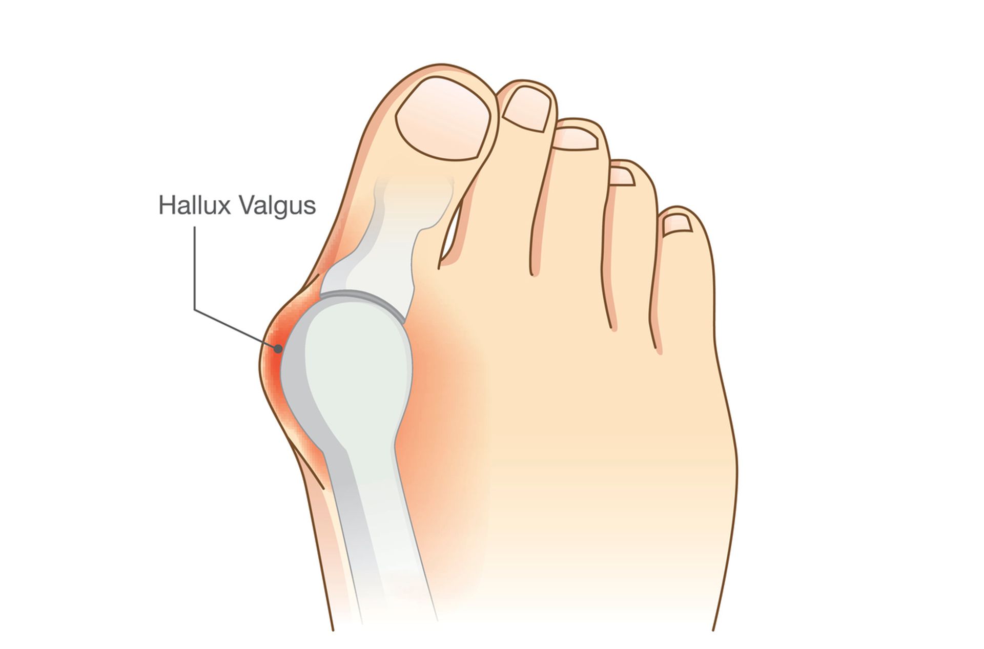 Chaussures pour best sale hallux valgus