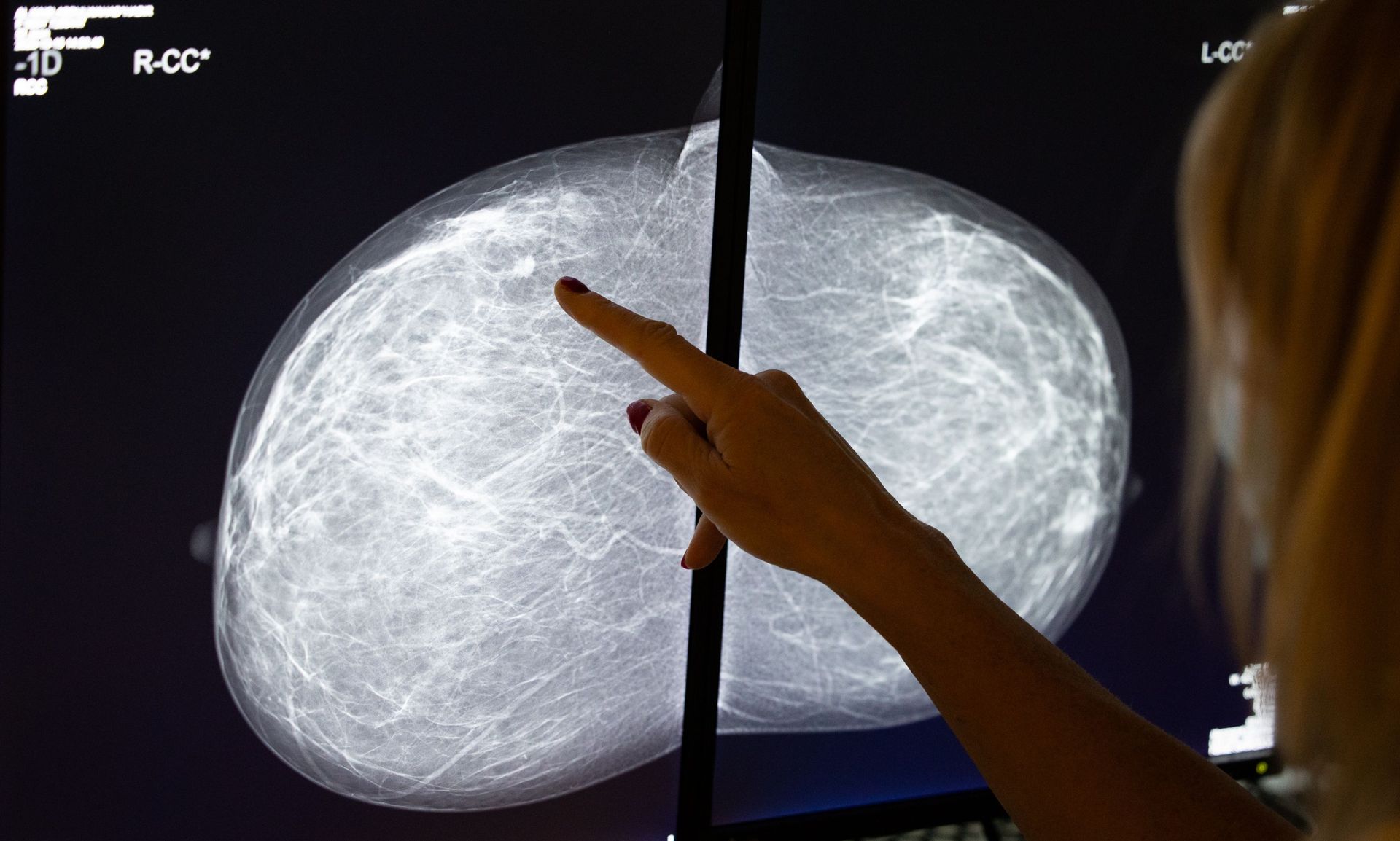 Mammographie à la Clinique Saint-Jean.