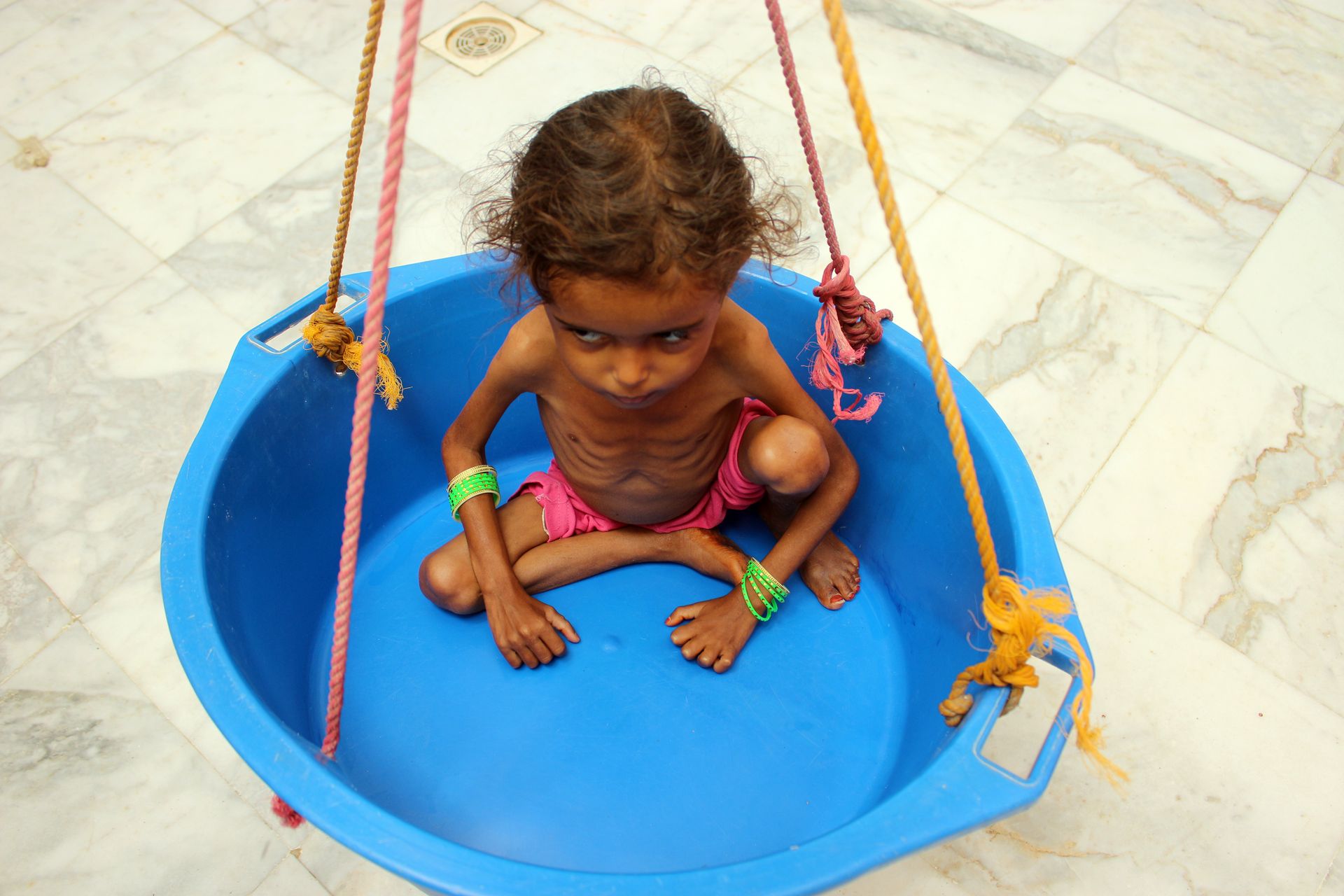 Une fille yéménite souffrant de malnutrition est pesée dans une clinique de la province de Hajjah, au nord du Yémen, le 5 février 2020.