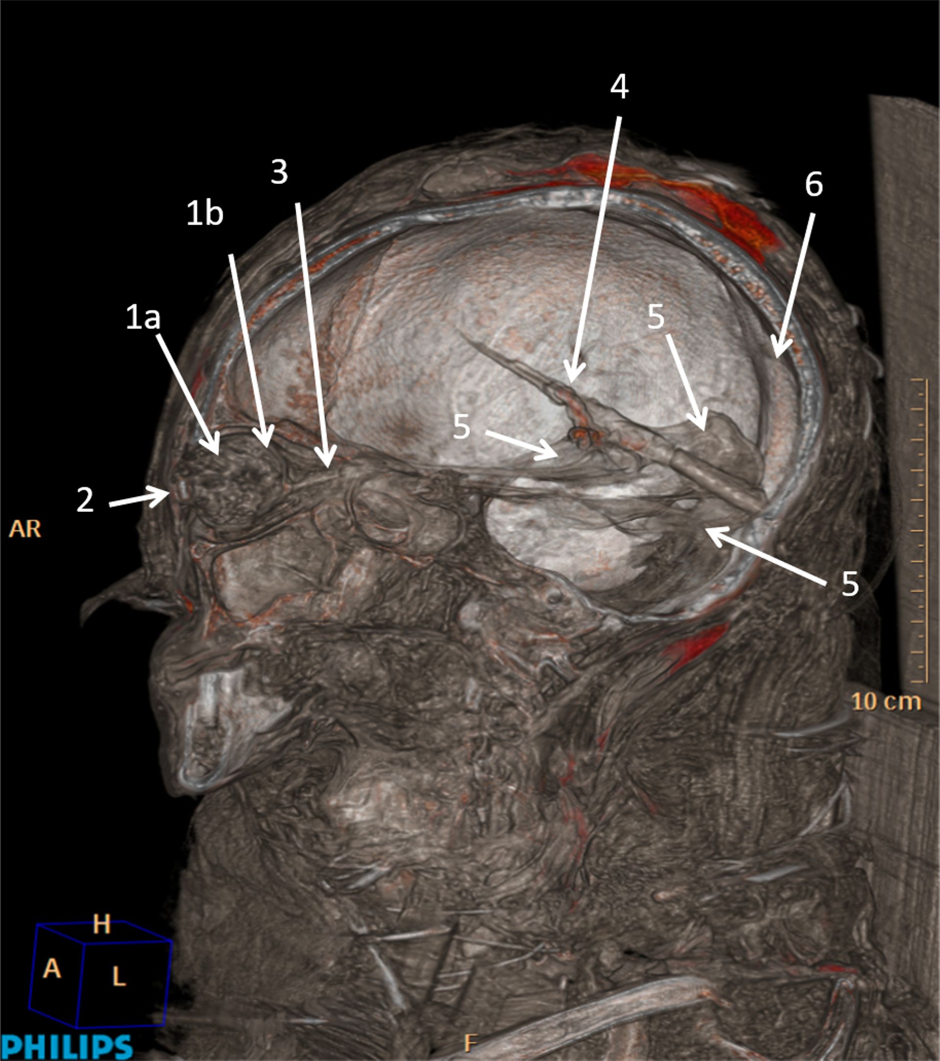 Reconstruction CT 3D de la tête et du cou de la momie, montrant l'intérieur du crâne. Vue latérale. 1a. Remplissage du globe oculaire. 1b. Phthisis bulbi. 2. Faux œil (cartonnage). 3. Nerf optique intact. 4. Bâton enfoncé dans la dure-mère à l'intérieur d