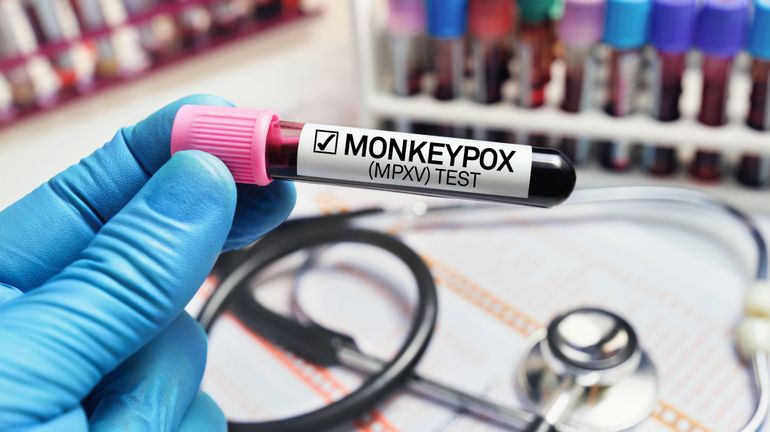 Variole du singe : l'épidémie de variole du singe semble se stabiliser, selon Sciensano