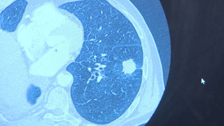 Jamais fumé une clope et pourtant atteint d'un cancer du poumon