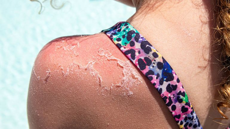 Cancer de la peau ou mélanome : 3 enfants sur 4 ont eu un sévère coup de soleil
