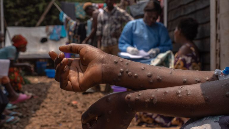 Mpox : l'Organisation mondiale de la santé déplore le manque de tests en RDC