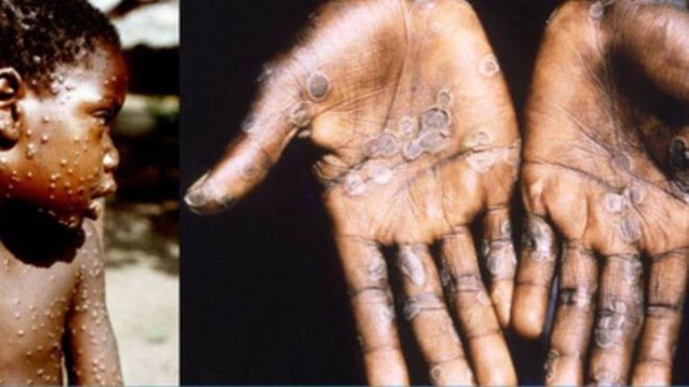 Des cas de variole du singe détectés en Europe et Amérique du Nord