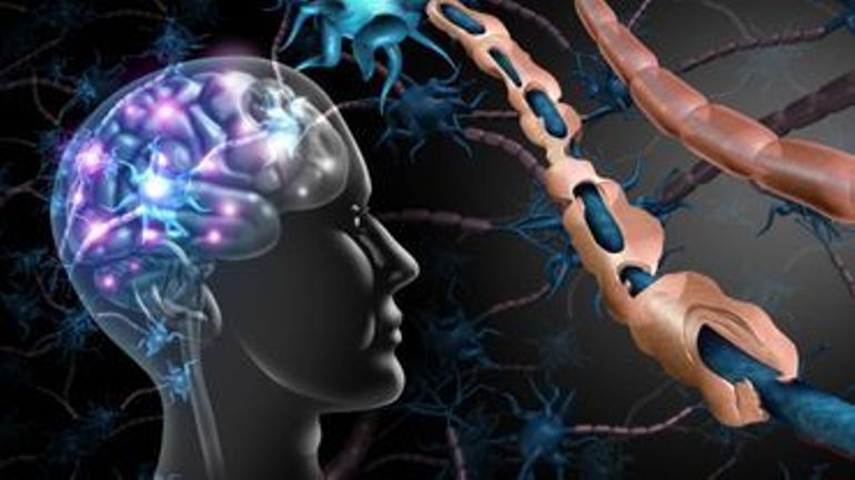 Sclérose en plaques : la perte neuronale est liée à une forte inflammation