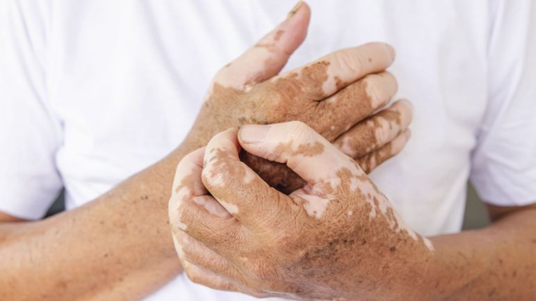 Pourquoi l’Opzelura, un traitement contre le vitiligo, est autorisé en France mais pas encore chez nous ?