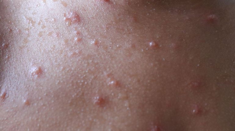 États-Unis : un deuxième enfant décède de l'épidémie de rougeole