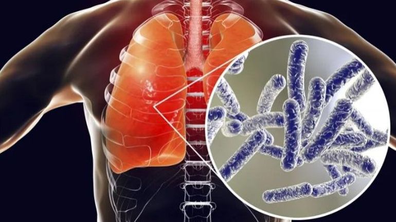 Légionellose : comprendre l'infection, son histoire et sa résurgence en 2025