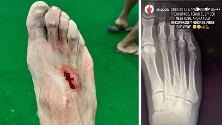Le pied d’un joueur de Cadiz dans un sale état après une faute d’Eden Hazard