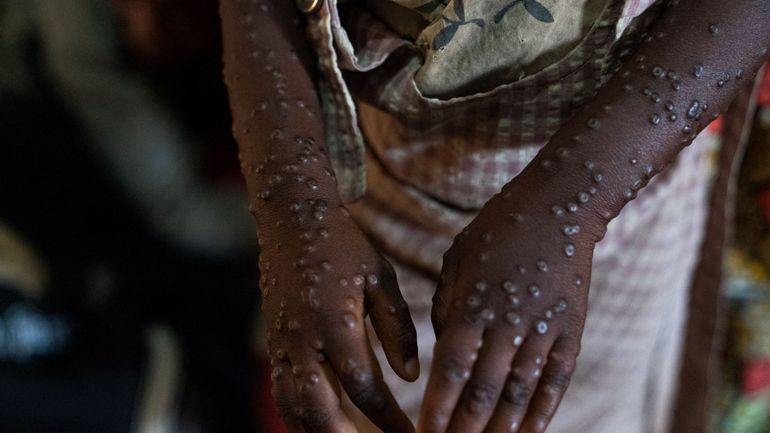 Mpox : près d'un million de doses de vaccin attendues en Afrique