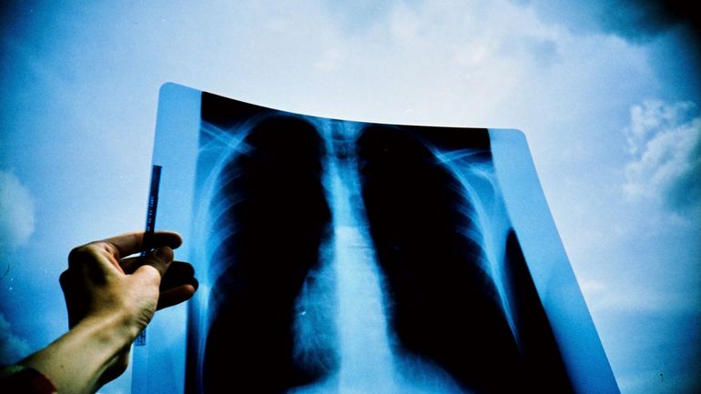 Une biotech liégeoise développe un nouveau traitement du cancer du poumon
