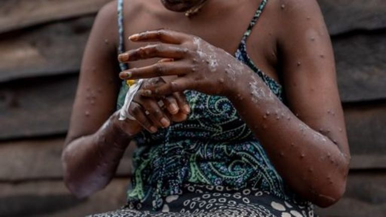 RDC : la campagne de vaccination contre le mpox repoussée sine die