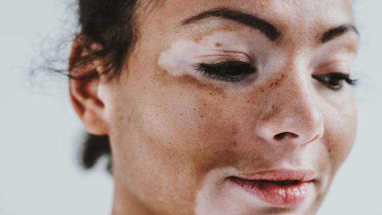 Un médicament révolutionnaire pour traiter le Vitiligo bientôt disponible