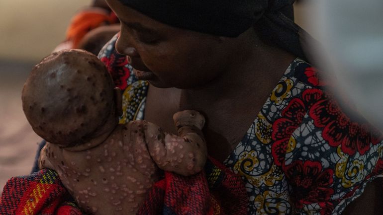 RDC : les premiers bébés ont été vaccinés contre le mpox